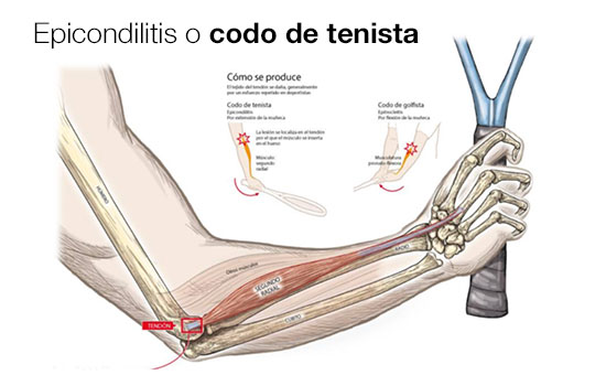 epicondilitis (codo de tenista), molestias en muñeca u hombro